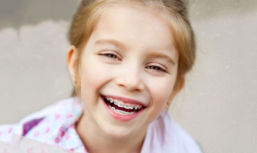 Trẻ nhỏ niềng không đúng cách có thể làm biến dạng khuôn mặt