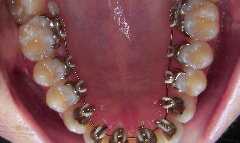 Khí cụ niềng răng làm gia tăng tỷ lệ vôi răng