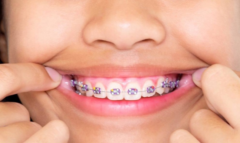 Niềng răng mắc cài là phương pháp niềng răng phổ biến