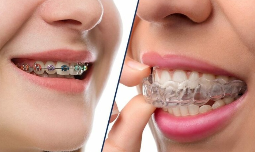 Niềng răng hô giá bao nhiêu sẽ tùy thuộc vào phương pháp mà bạn lựa chọn