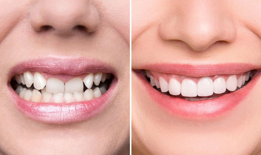 Giá niềng răng Invisalign sẽ tùy thuộc vào mức độ lệch lạc của răng