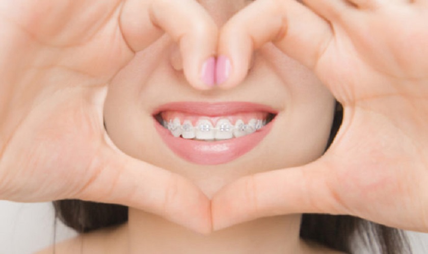 Niềng răng mắc cài sứ