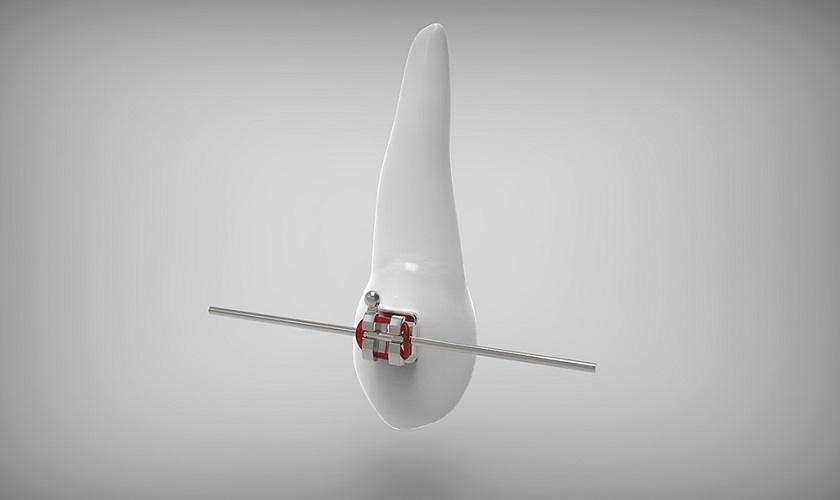 Giá niềng răng mắc cài cập nhật mới nhất