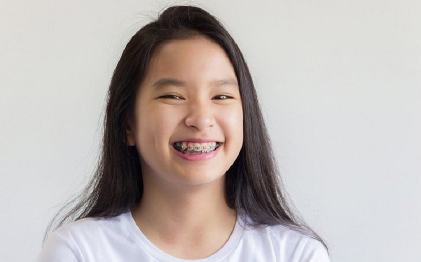 Niềng răng sớm sẽ giúp đẩy nhanh tốc độ chỉnh răng