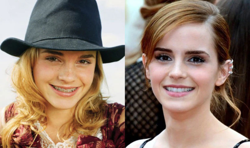 Niềng răng tại Nha khoa Nhân Tâm