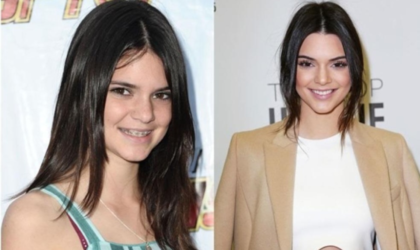 Niềng răng tại Nha khoa Nhân Tâm