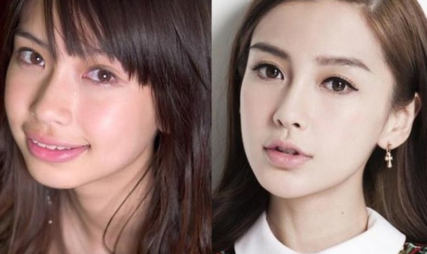 Niềng răng tại Nha khoa Nhân Tâm