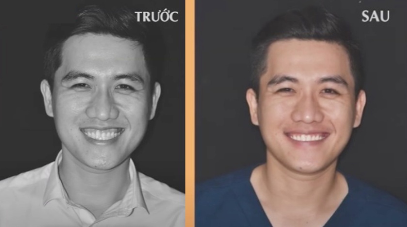 Niềng răng tại Nha khoa Nhân Tâm