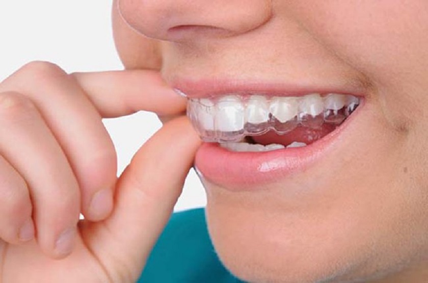 Công nghệ niềng răng vô hình invisalign