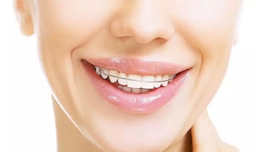 Tại sao việc đeo máng duy trì sau niềng răng quan trọng sau khi gỡ mắc cài?
