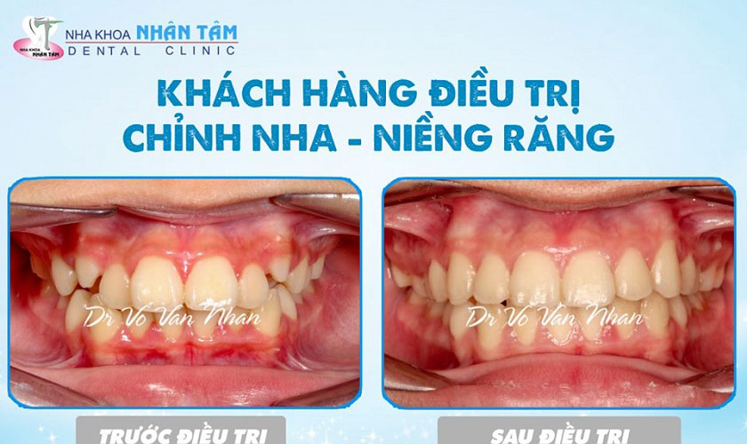 Hình ảnh thực tế của khách hàng niềng răng tại nha khoa Nhân Tâm