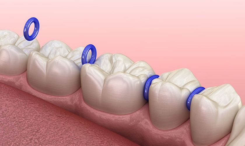 Giai đoạn đặt thun tách kẽ có thể gây cảm giác đau nhức