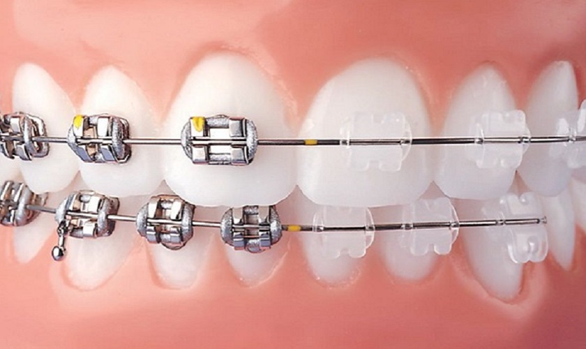 Phương pháp niềng sẽ quyết định niềng 2 răng cửa bị hô bao nhiêu tiền