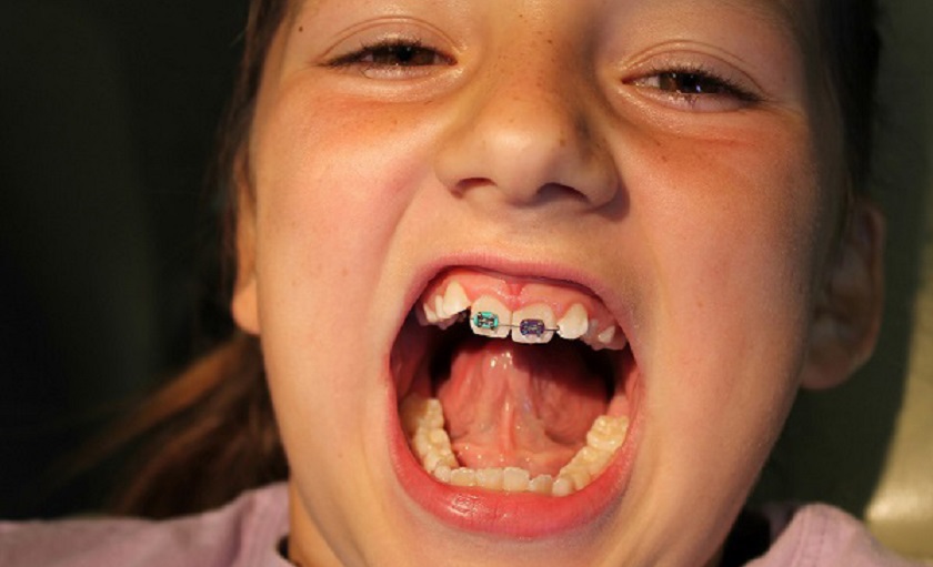 Niềng 2 răng cửa thường chỉ được sử dụng đối với trẻ em đang trong thời kỳ mọc răng vĩnh viễn