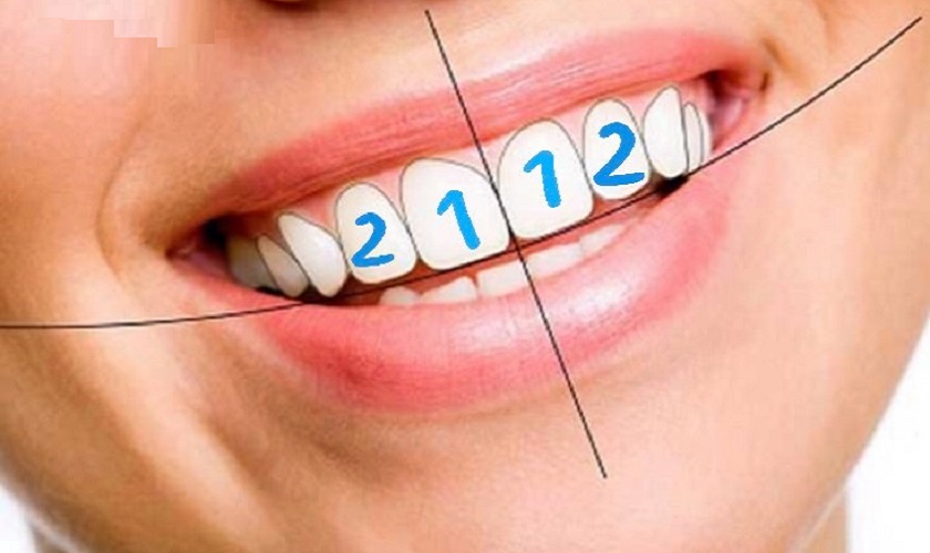 Niềng 2 răng cửa mất bao lâu?