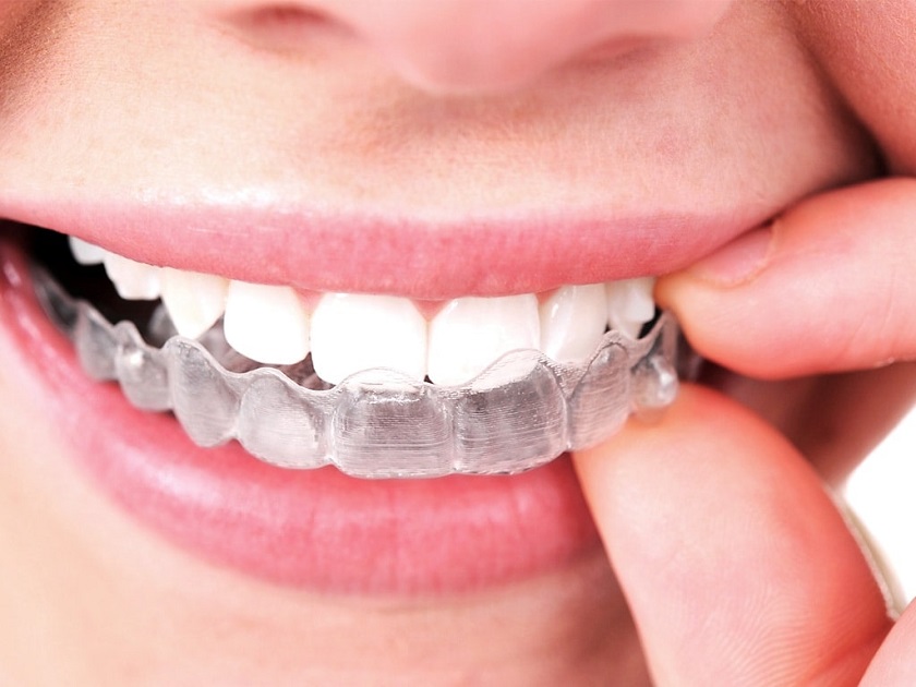 Niềng răng trong suốt invisalign