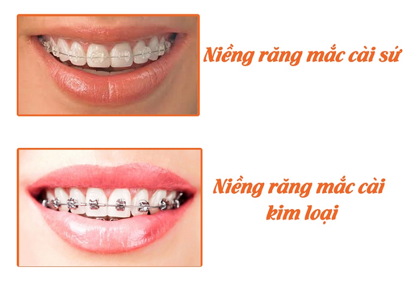 Loại khí cụ ảnh hưởng đến niềng răng 1 hàm bao nhiêu tiền