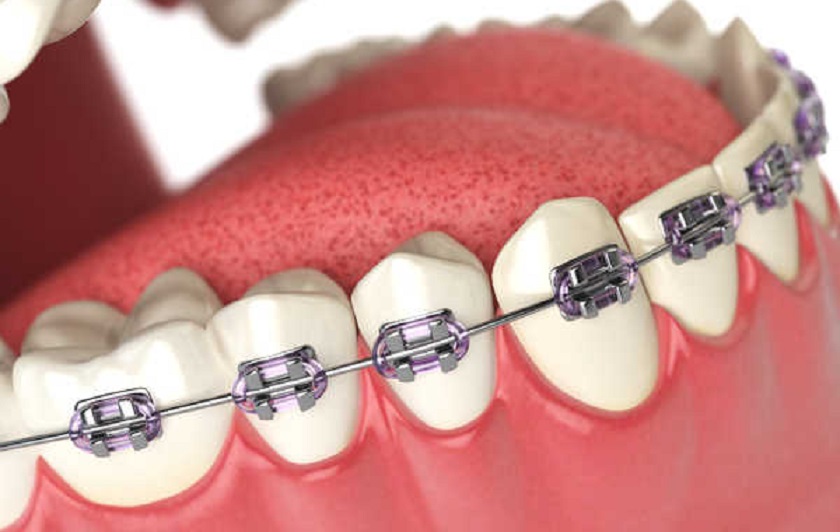 Niềng răng 1 hàm mất bao lâu? Chi phí thế nào?