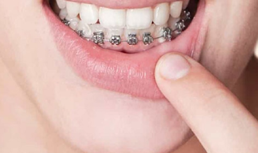 Điều trị niềng răng 1 hàm mất bao lâu và những thông tin bạn cần biết