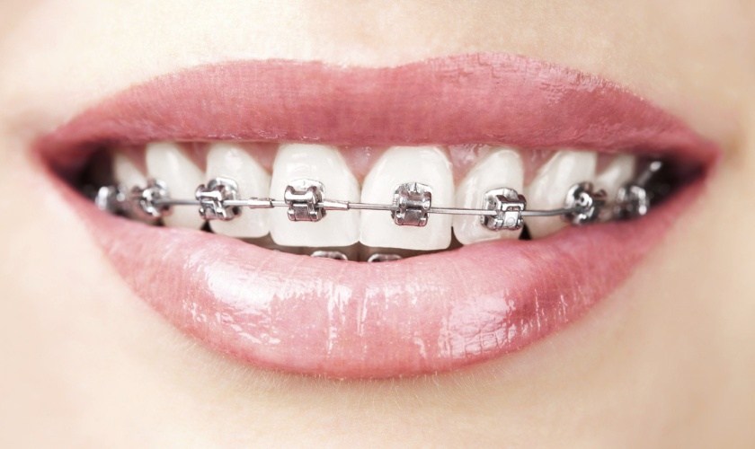 Niềng răng ở đâu tốt TP.HCM hiện nay?