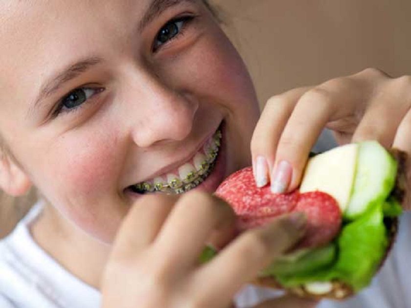 Tìm hiểu niềng răng ăn được những gì là việc làm quan trọng và cần thiết