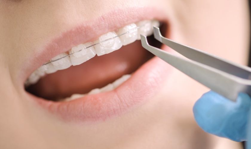 Niềng răng mắc cài sứ mang đến nhiều ưu điểm vượt trội