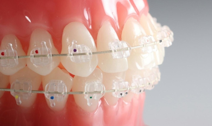 Niềng răng mắc cài sứ tự đóng