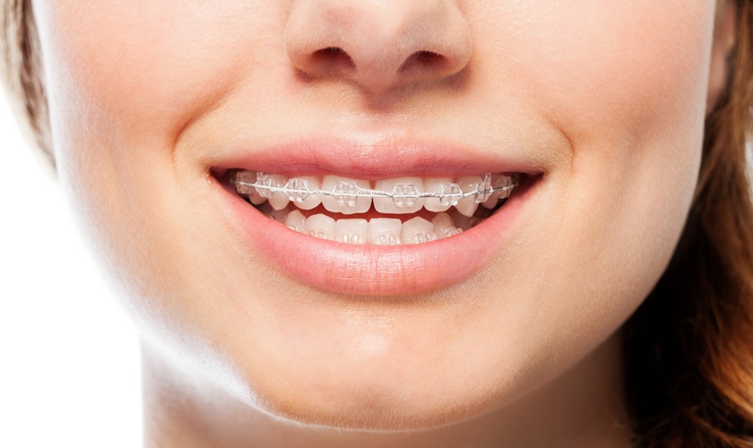 Niềng răng bằng sứ và những điều cần biết