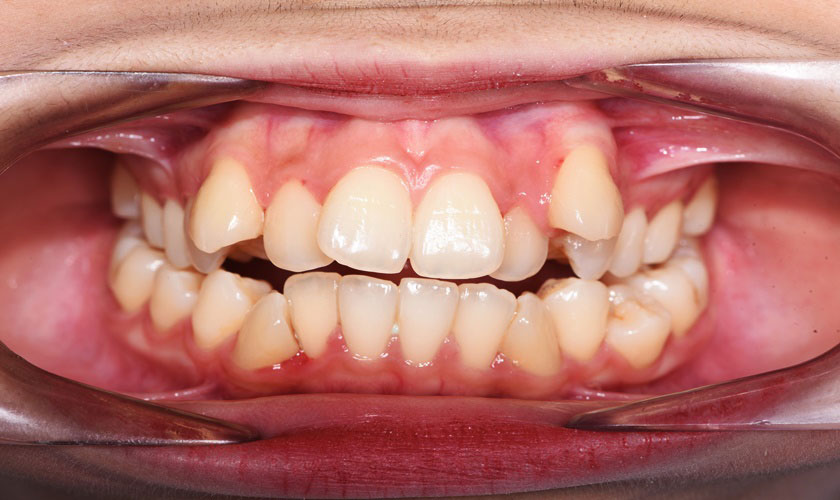 Niềng răng giá bao nhiêu còn tùy thuộc vào tình trạng răng của mỗi người