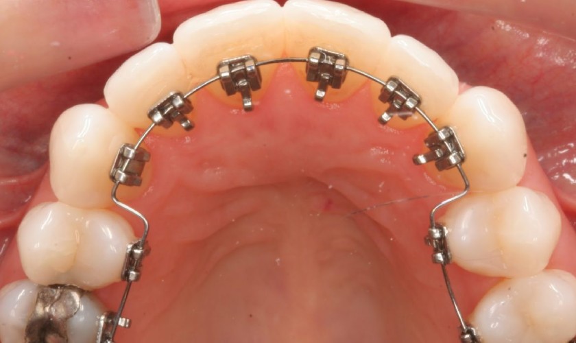 Niềng răng bên trong là phương pháp được nhiều người lựa chọn