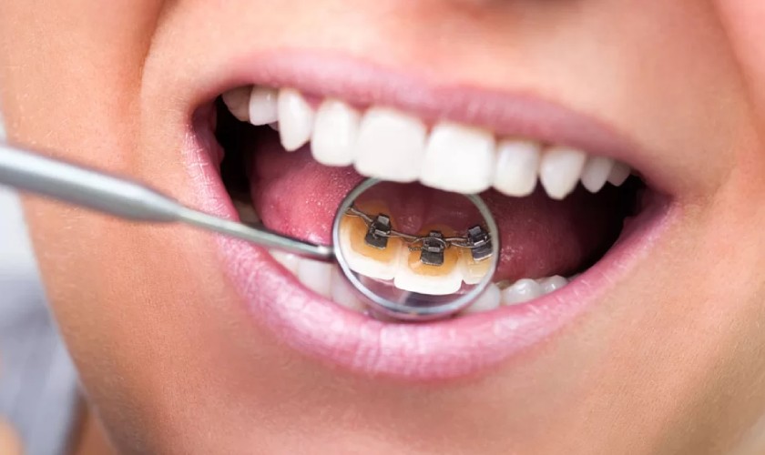 Niềng răng bên trong đảm bảo tính thẩm mỹ ngay cả trong khi niềng