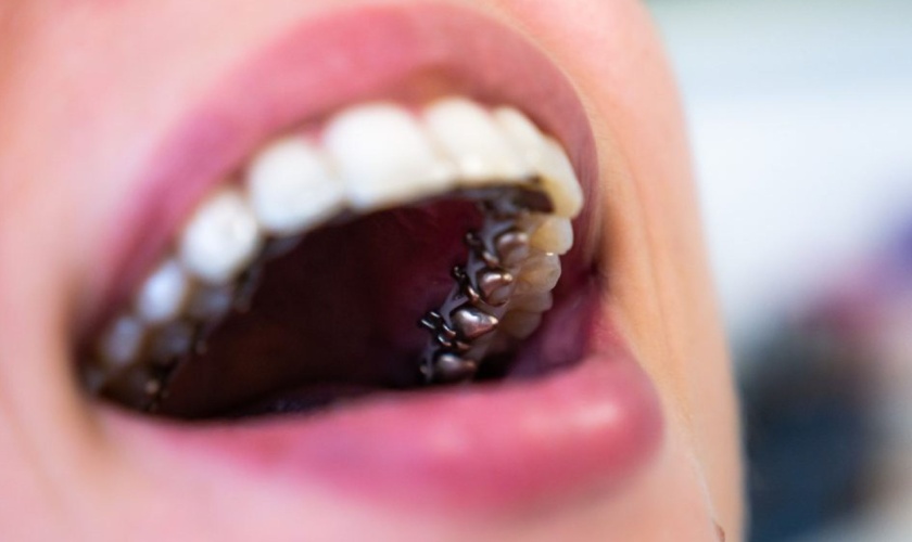 Niềng răng bên trong có tính thẩm mỹ rất cao