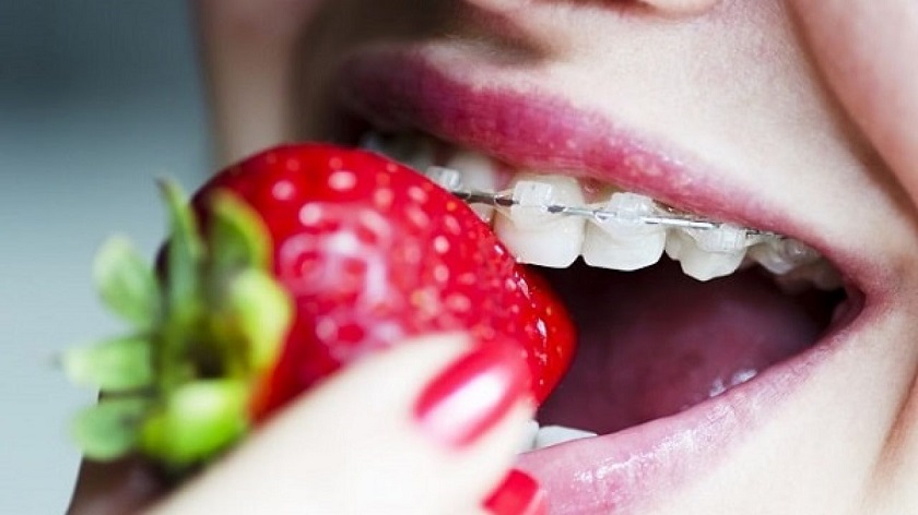 Vệ sinh niềng răng triệt để bằng chỉ nha khoa