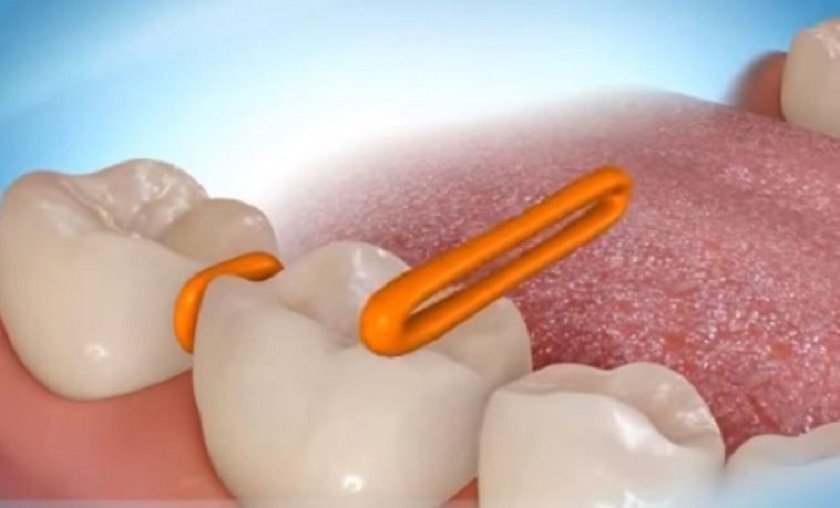 Gắn thun tách kẽ