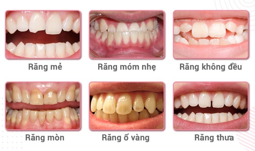 Niềng răng giúp khắc phục một số khiếm khuyết nha khoa