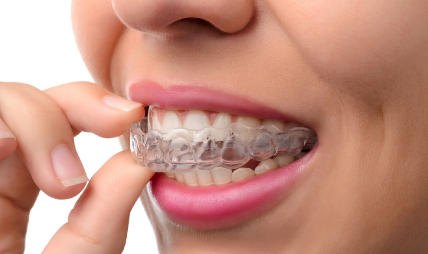 Niềng răng trong suốt Invisalign có chi phí cao nhất trong các loại niềng răng