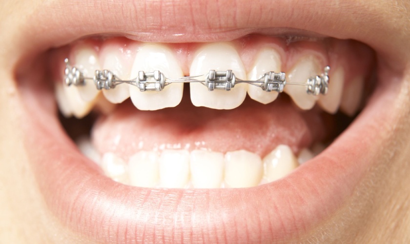 Niềng răng một hàm vẫn có thể thực hiện được