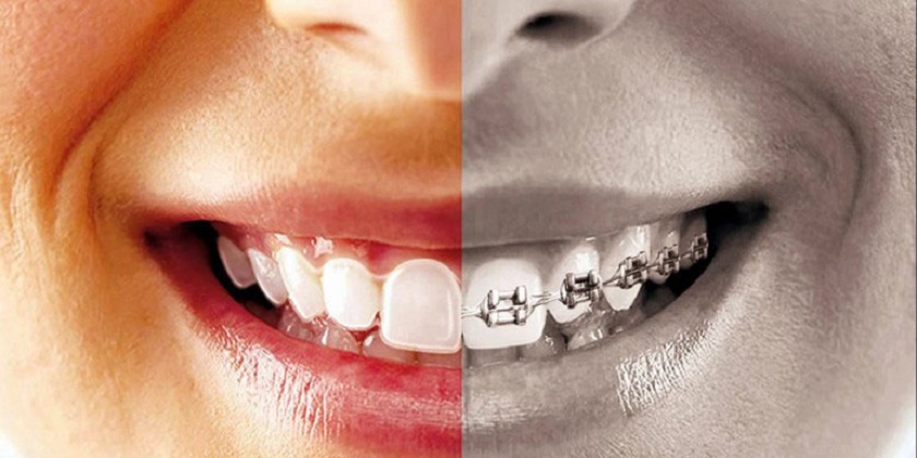 Niềng răng Invisalign mang lại hiệu quả vượt trội về mặt thẩm mỹ