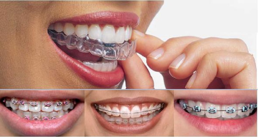 Phương pháp niềng là yếu tố ảnh hưởng tới chi phí chỉnh nha