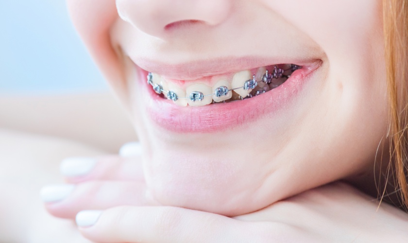 Niềng răng hỏng: Nguyên nhân và cách khắc phục