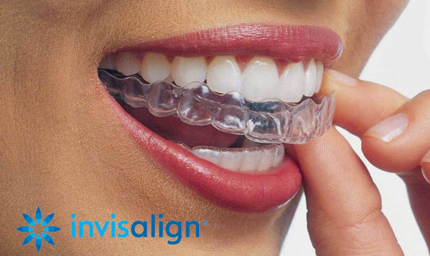 Niềng răng Invisalign được rất nhiều người ưa chuộng
