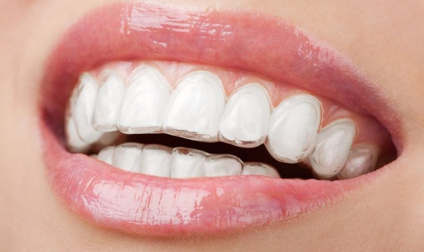 Invisalign sở hữu nhiều ưu điểm vượt trội