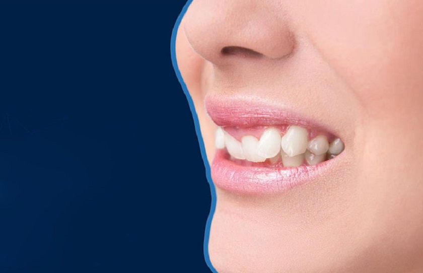 Niềng răng khấp khểnh có lâu không?