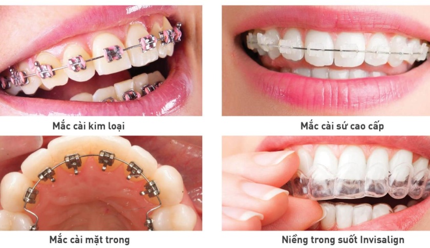 Thời gian niềng răng mất bao lâu sẽ tùy thuộc vào phương pháp niềng răng