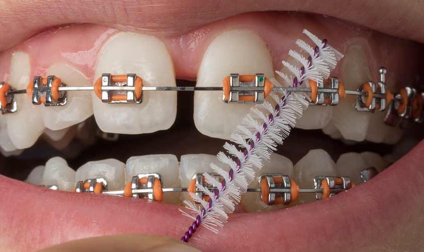 Trường hợp răng thưa có thể không cần nhổ răng