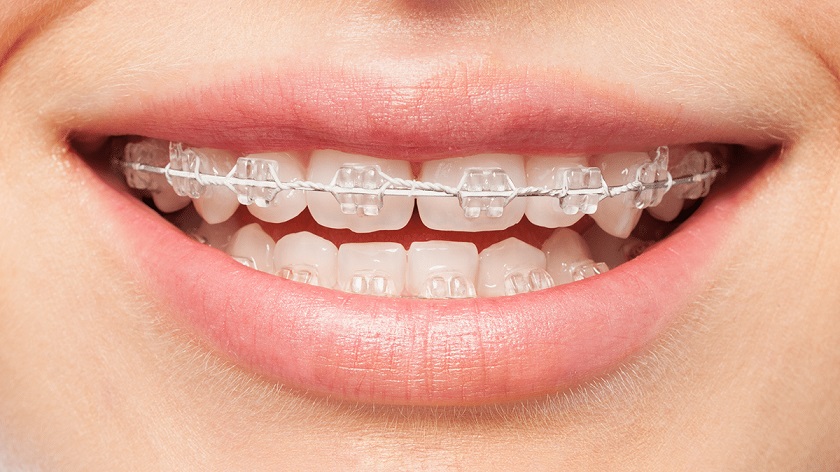 Niềng răng mắc cài sứ với dây cung kim loại