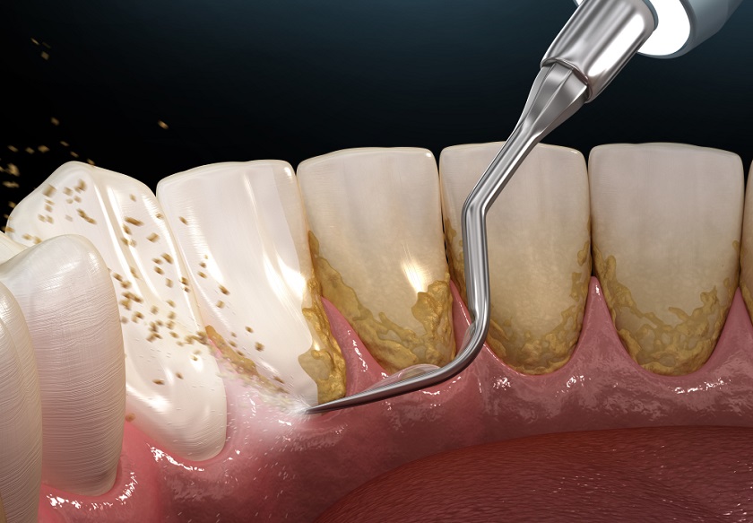 Vệ sinh răng miệng trước khi niềng