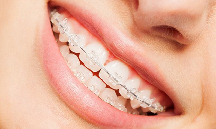 Mắc cài sứ tự buộc đảm bảo thẩm mỹ