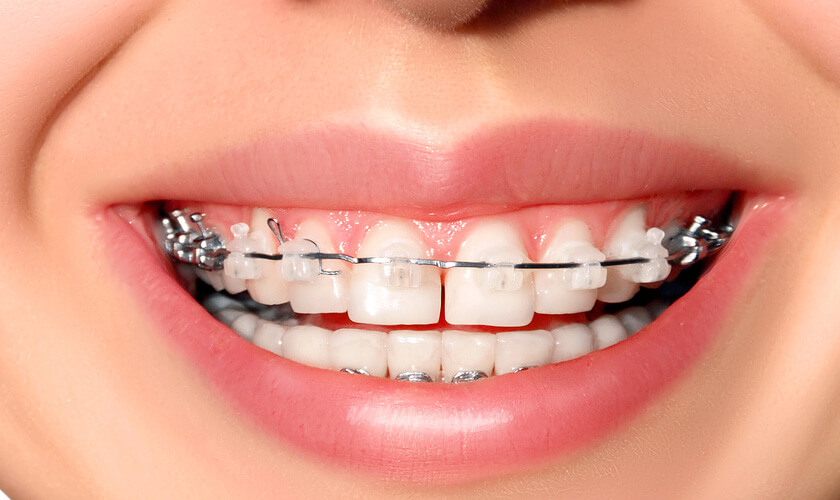 Niềng răng mắc cài sứ mang đến nhiều ưu điểm vượt trội