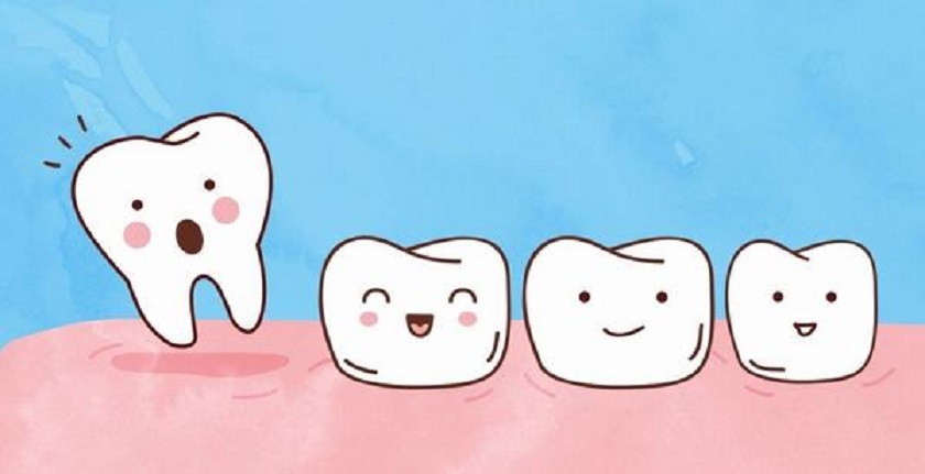 Niềng răng phải nhổ răng nhằm tạo khoảng trống để di chuyển răng trong một số trường hợp cần thiết